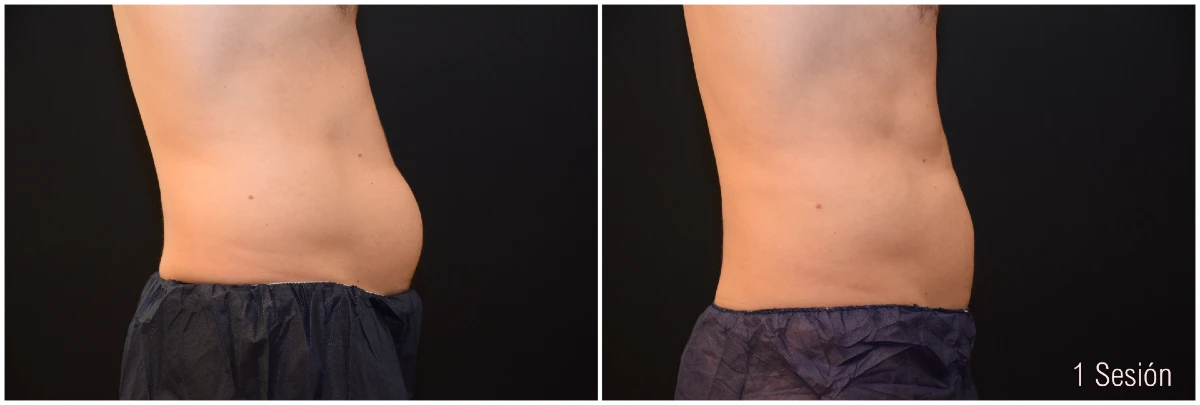 Foto Antes y Después de Criolipólisis Abdomen Hombre 1 Sesión