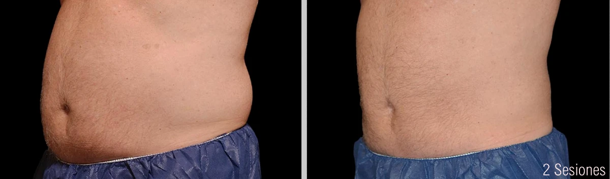 FOto Antes y Después de Criolipólisis Abdomen Hombre 2 Sesiones