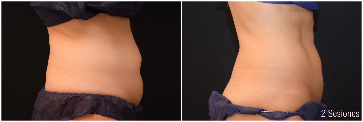  Foto Antes y Después Criolipólisis Abdomen Mujer 2 Sesiones