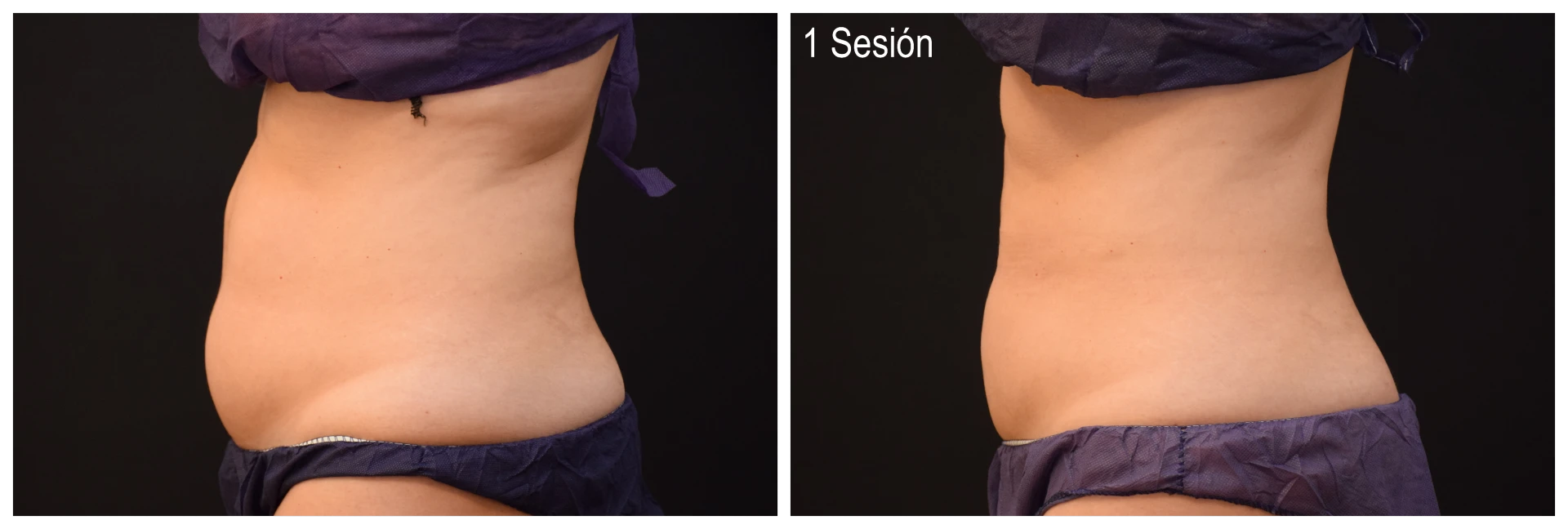 Foto Antes y Después Coolsculpting Abdomen Mujer 1 Sesión