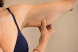 Tratamiento Coolsculpting Brazos en Clínica Roso Rodrigues