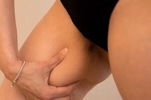 Tratamiento Coolsculpting Muslos en Clínica Roso Rodrigues