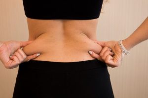 Tratamiento Coolsculpting Flancos en Clínica Roso Rodrigues