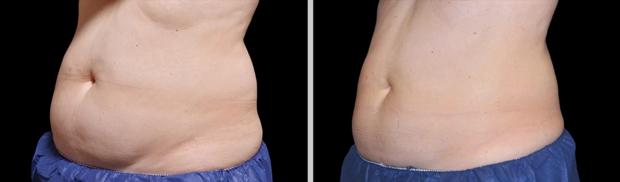 Fotos de Antes y Después de Coolscultping Abdomen en Hombre
