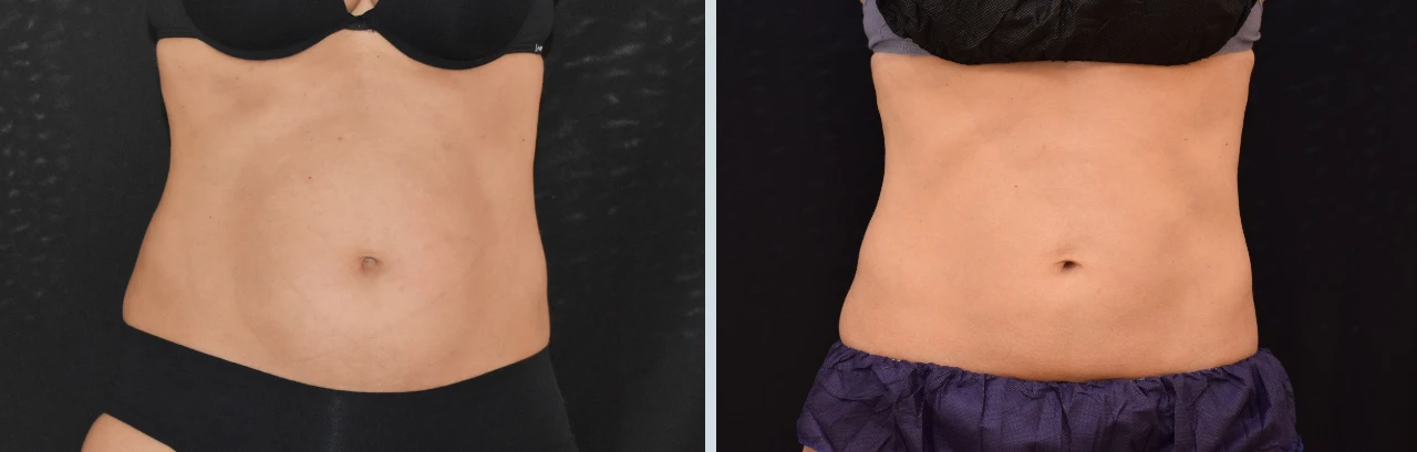 Fotos Antes y Después de Coolscultping Abdomen en Mujer