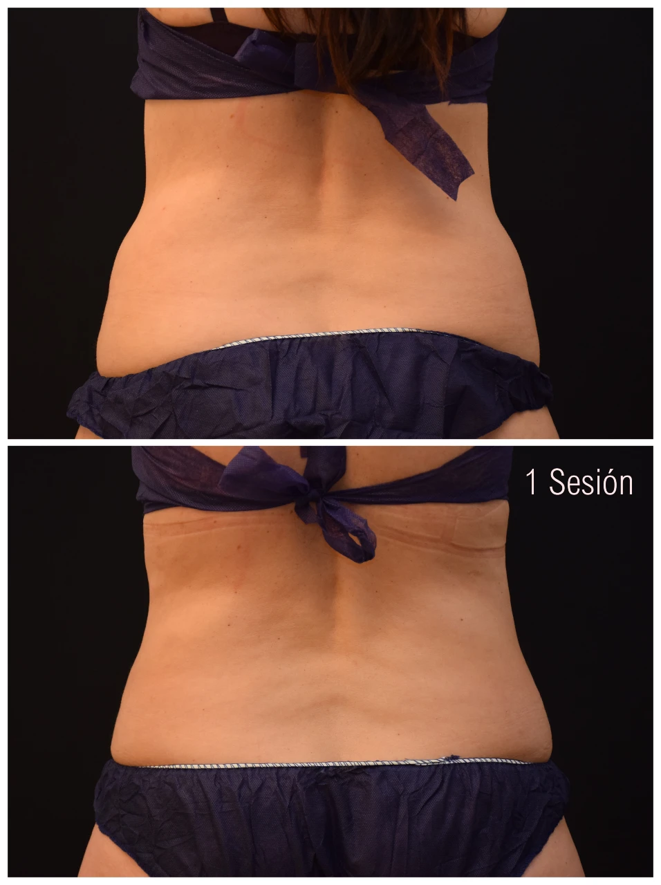 Fotos de Antes y Después de Coolscultping Flancos en Mujer