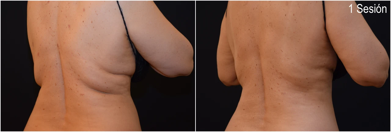 Fotos Antes y Después de Coolscultping Flancos en Mujer