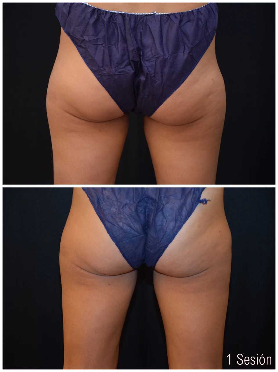 Fotos de Antes y Después de CoolSculpting Gluteos Mujer