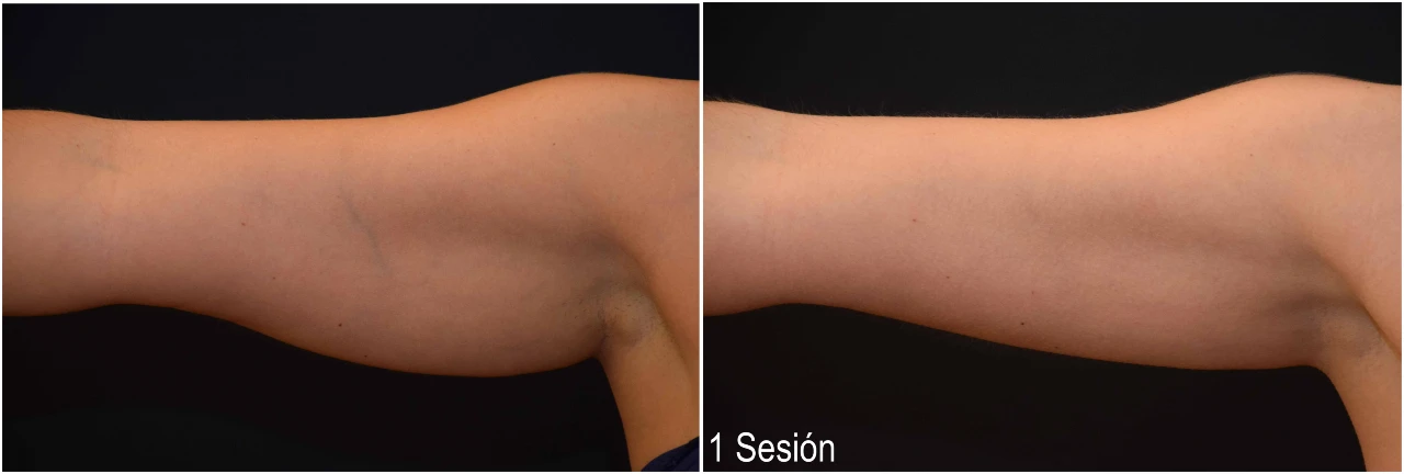 Fotos Antes y Después Eliminar Grasa Localizada en Brazos de Mujer