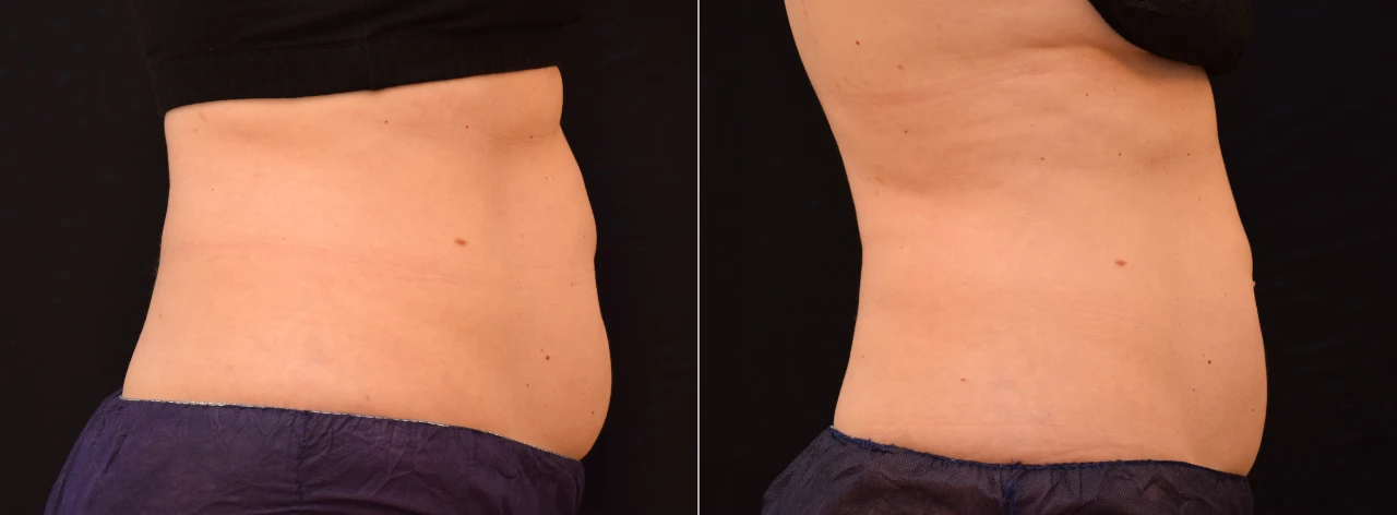 Fotos Antes y Después Eliminar Grasa Localizada en Andomen de Mujer