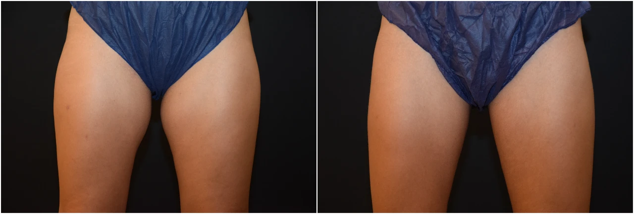 Fotos Antes y Después Eliminar Grasa Localizada en Cartucheras de Mujer