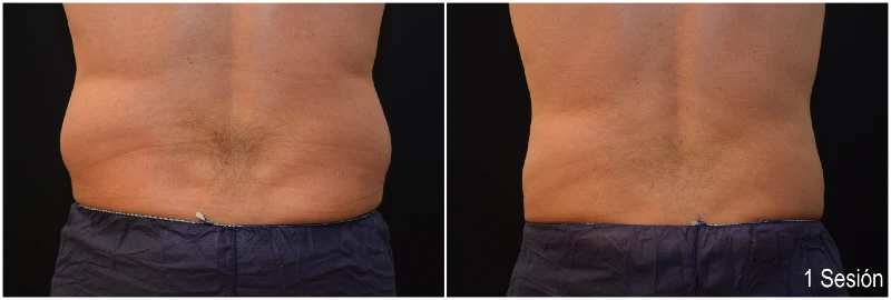 Foto Antes y Después Criolipólisis Flancos Hombre