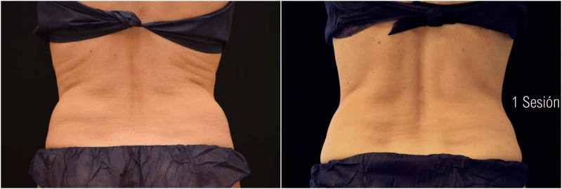 Criolipolisis Flancos Mujer 1 Sesión Coolsculpting Flancos Mujer 1 Sesión