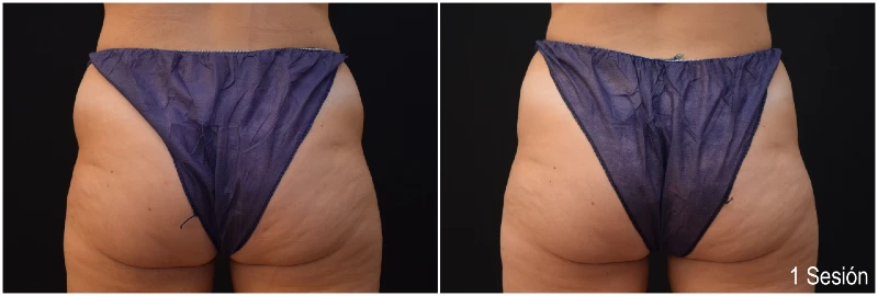 Foto Antes y Después CoolSculpting Flancos Hombre