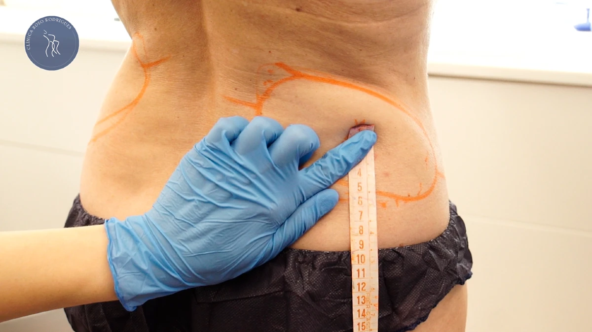 Medición zonas de CoolsCulpting Flancos