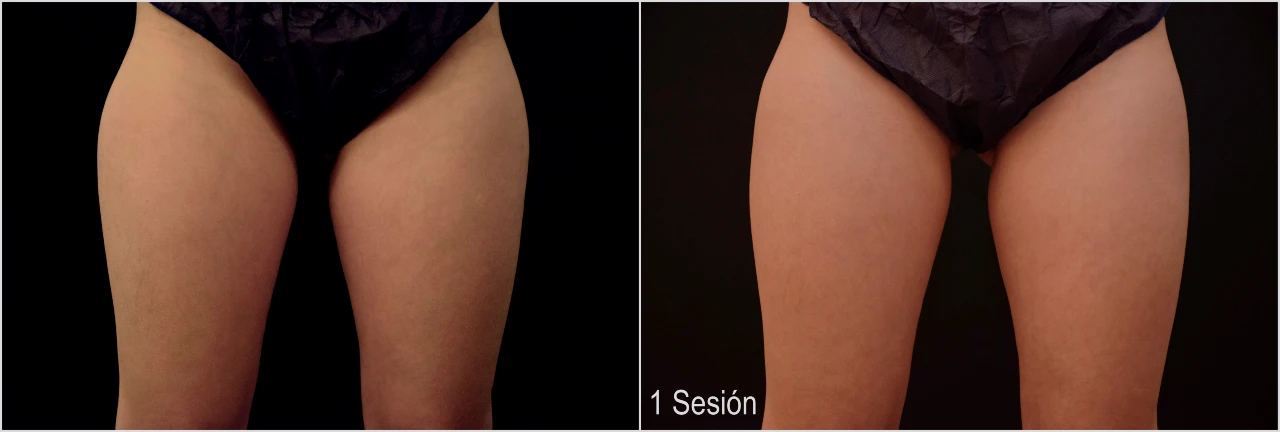 Fotos Antes y Después Tratamiento CoolSculpting Cartucheras 1 Sesión en Clinica Roso Rodrigues