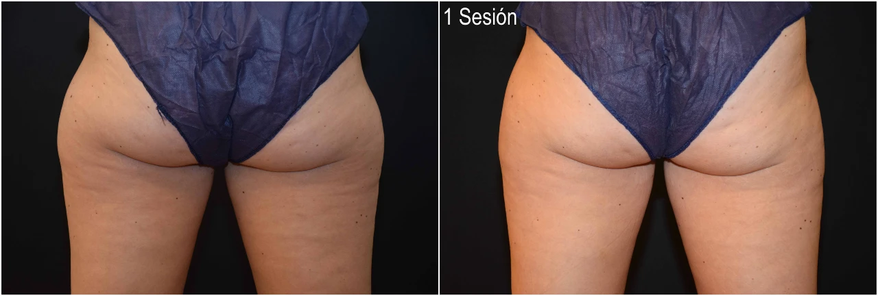 Fotos Antes y Después Tratamiento CoolSculpting Cartucheras 1 Sesión en Clinica Roso Rodrigues