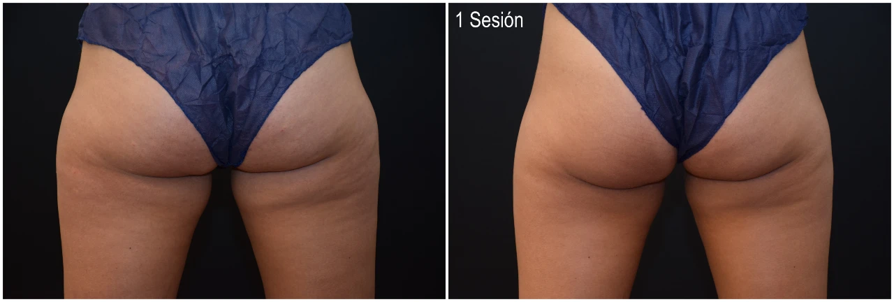 Fotos Antes y Después Tratamiento Criolipólisis Cartucheras 1 Sesión en Clinica Roso Rodrigues