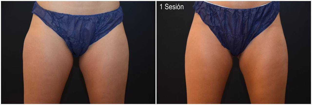 Fotos Antes y Después Tratamiento CoolSculpting Cartucheras 1 Sesión en Clinica Roso Rodrigues