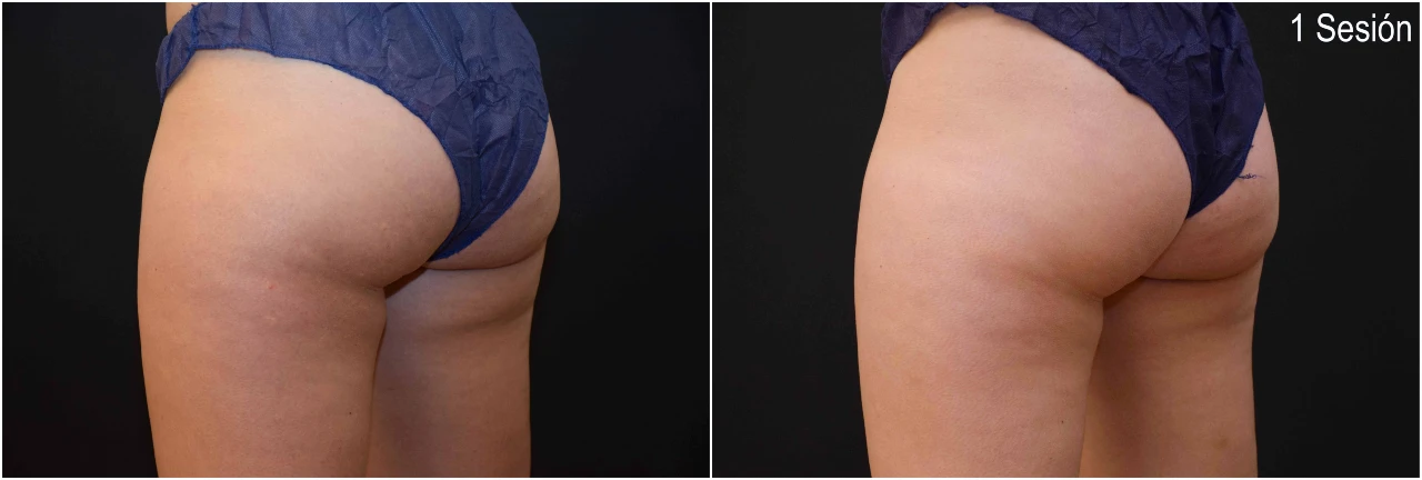 Fotos Antes y Después CoolSculpting Banana Roll en Clínica Roso Rodrigues