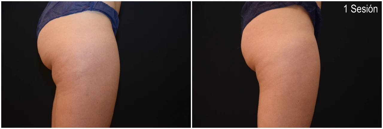 CoolSculpting Banana Roll en Clínica Roso Rodrigues