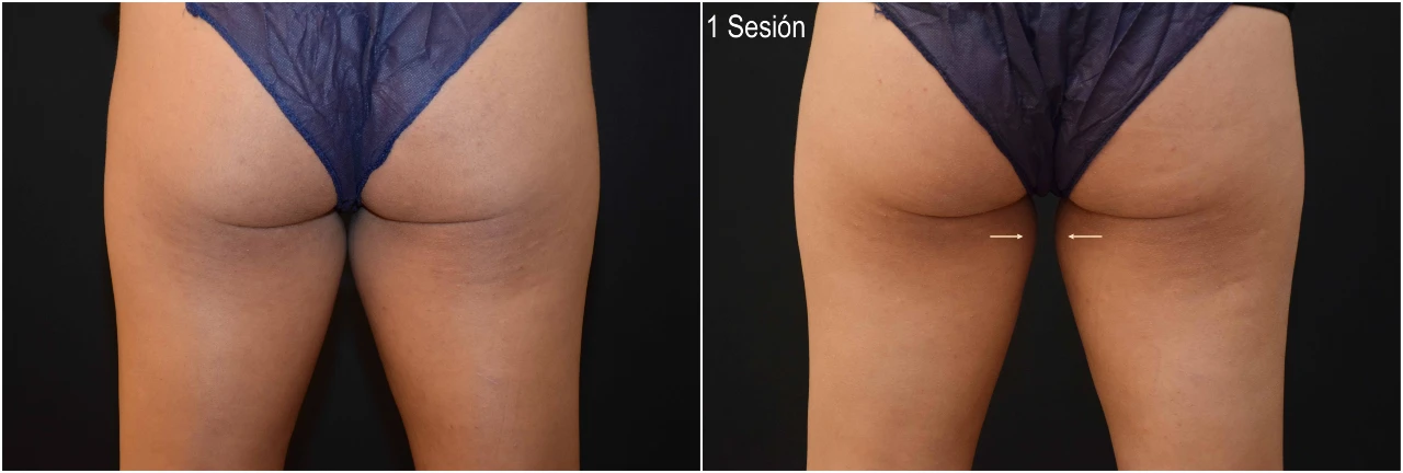 Antes y despúes de CoolSculpting Muslos en Clinica Roso Rodrigues