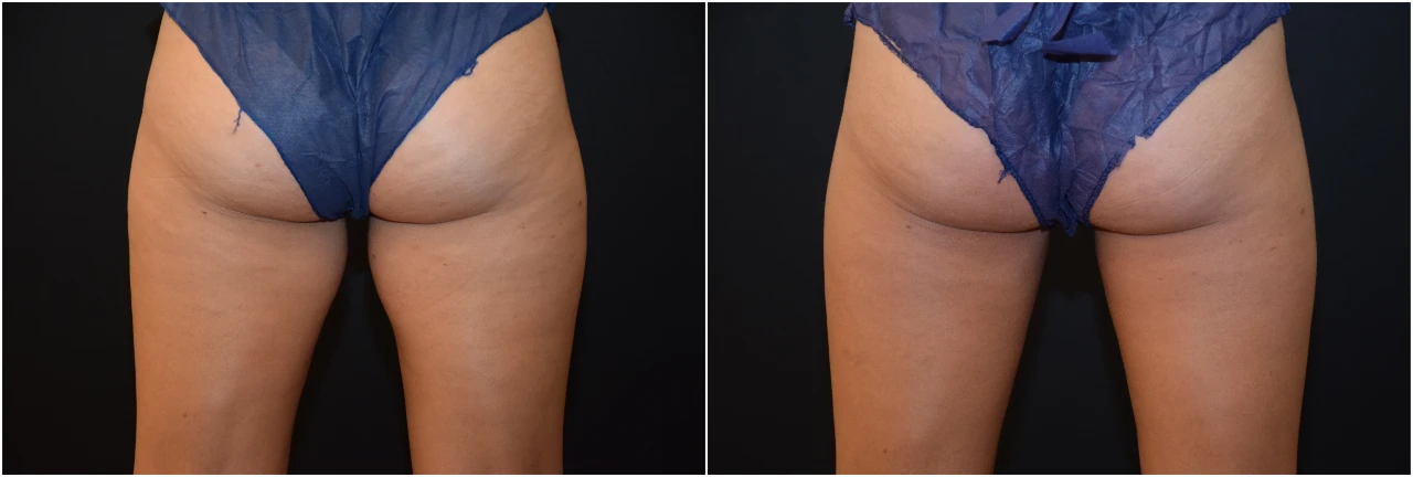 Antes y después de CoolSculpting Muslos en Clinica Roso Rodrigues