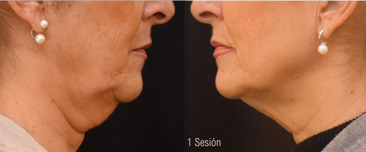 Antes y Después CoolSculpting Papada Mujer 1 Sesión