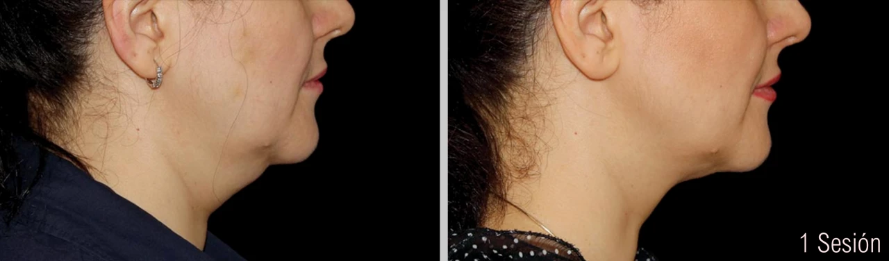 Antes y Después Criolipólisis Papada Mujer 1 Sesión