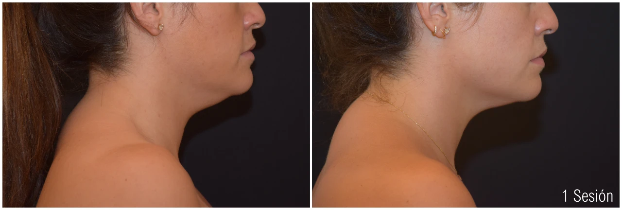 Antes y Después Coolsculpting Papada Mujer 1 Sesión