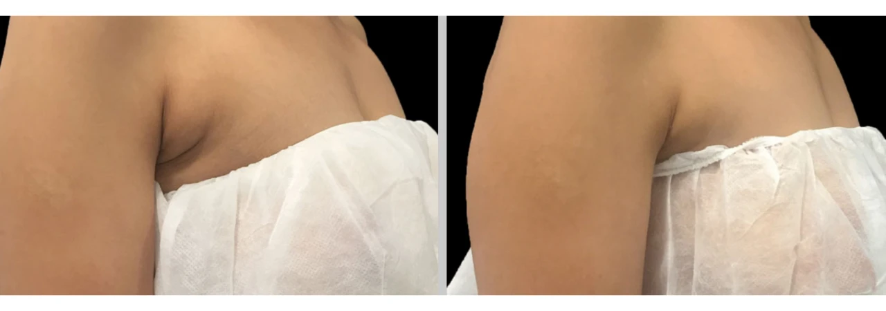 CoolSculpting Bra-Fat Mujer