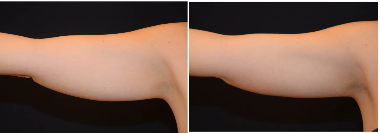 CoolSculpting Brazos Mujer 1 Sesión