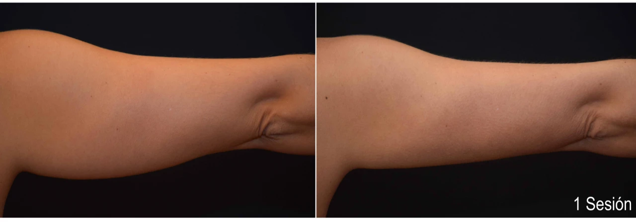 CoolSculpting Brazos Mujer 1 Sesión