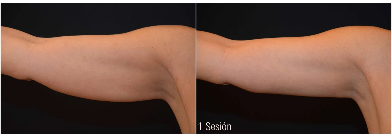 Criolipólisis Brazos Mujer 1 Sesión