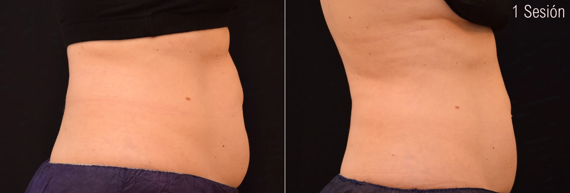 Antes y después del tratamiento Criolipólisis Abdomen