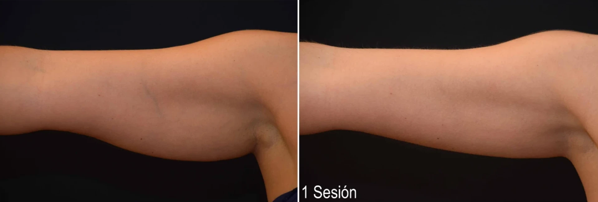 Antes y después del tratamiento Criolipólisis Brazos