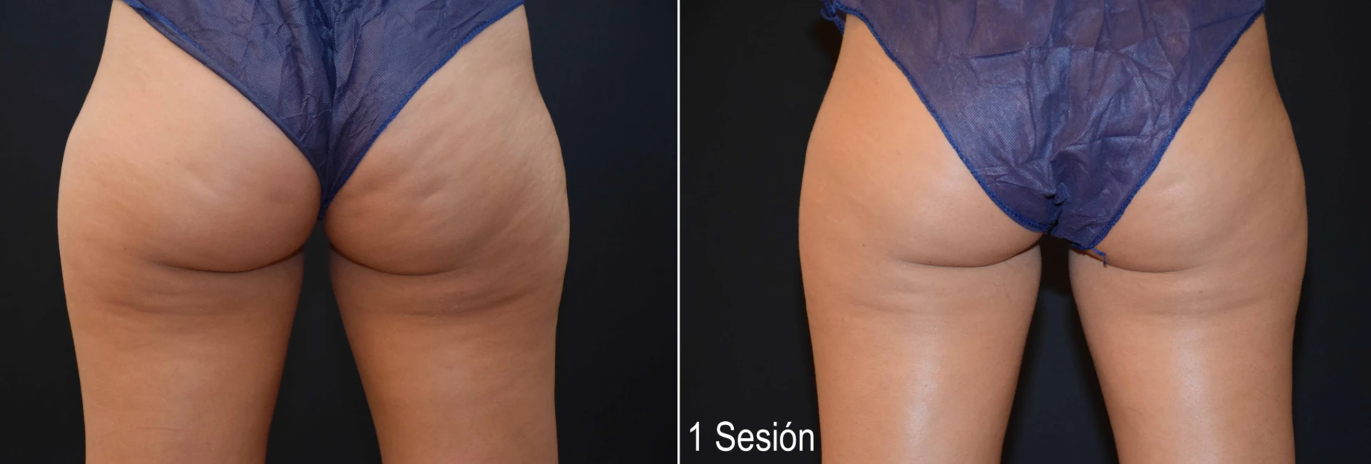 Antes y después del tratamiento Criolipólisis Cartucheras