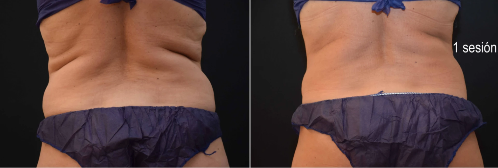 Antes y después del tratamiento Criolipólisis Flancos