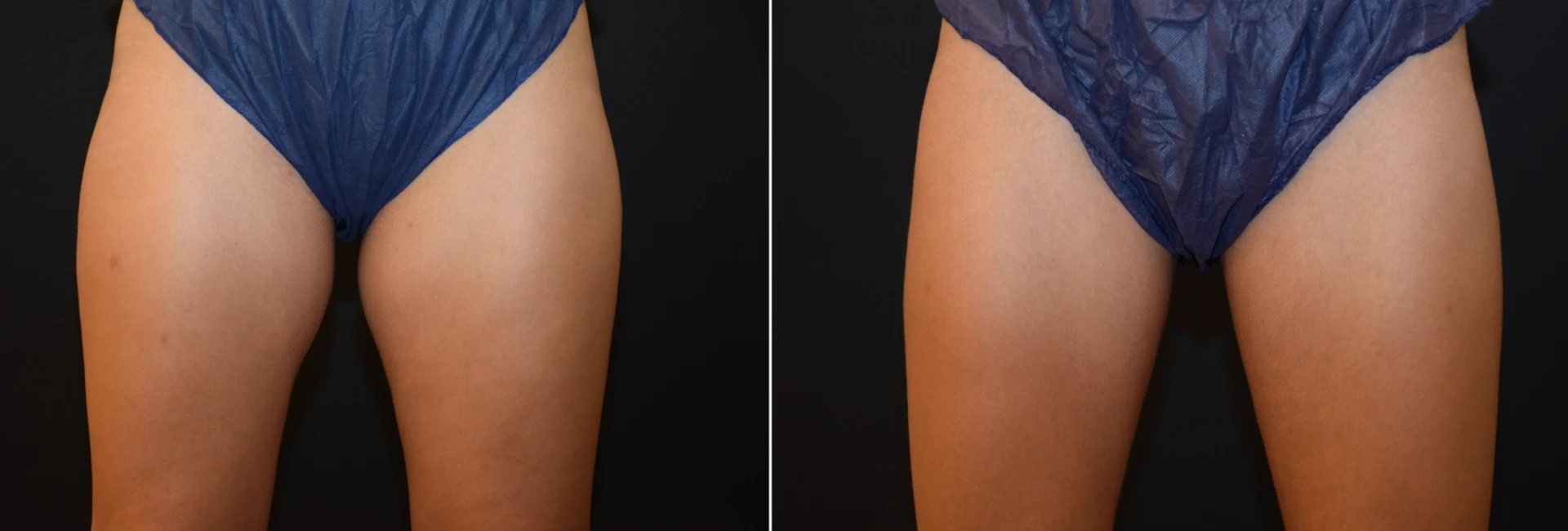 Antes y después del tratamiento Criolipólisis Muslos