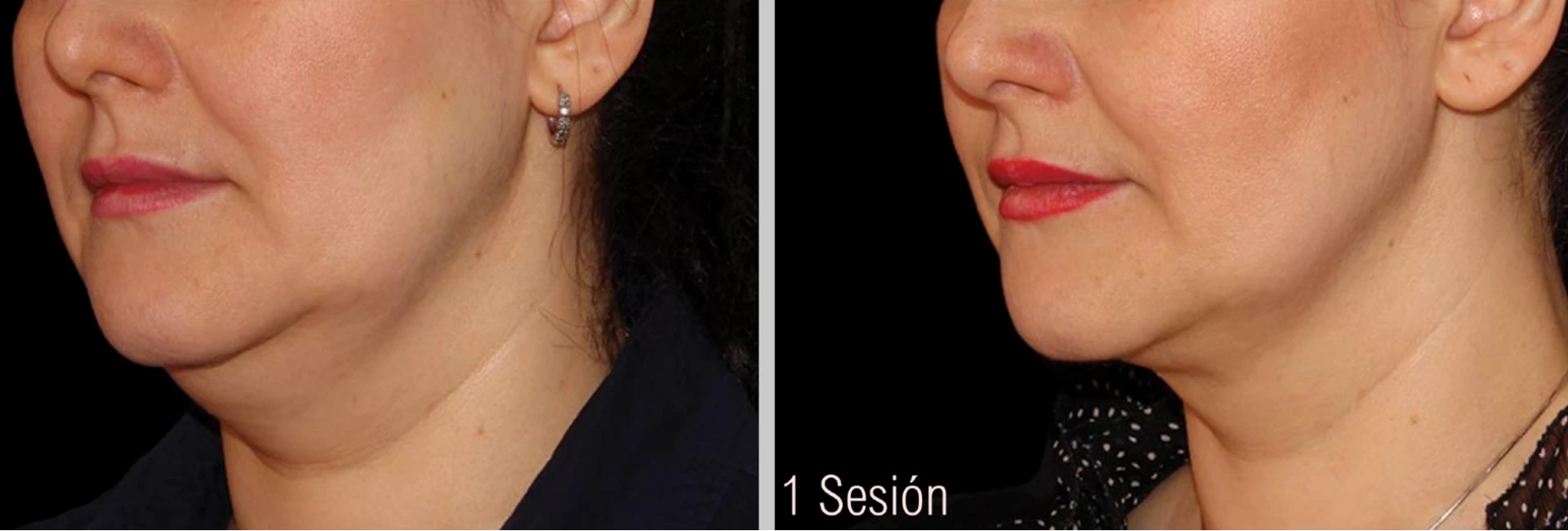 Antes y después de Criolipólisis Papada