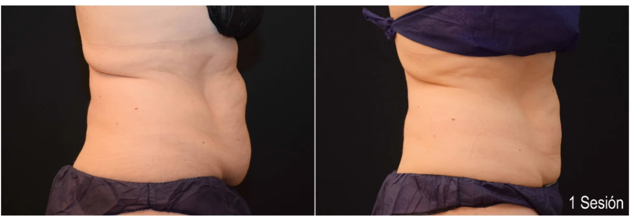 Antes y Después de Liposucción sin Cirugía en Abdomen con Coolsculpting