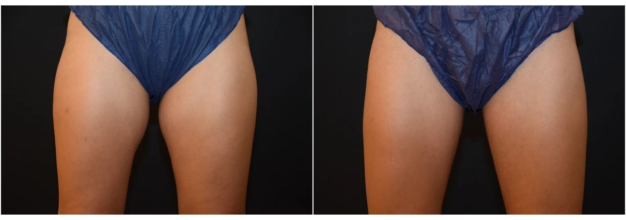 Antes y Después de Liposucción sin Cirugía en Muslos con Coolsculpting