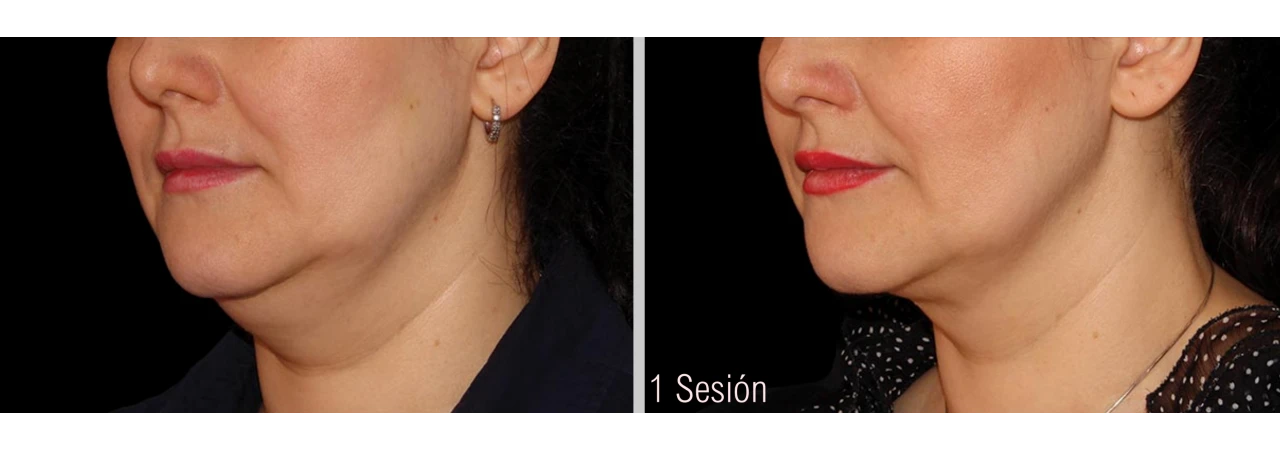 Antes y Después de Liposucción sin Cirugía en Papada con Coolsculpting