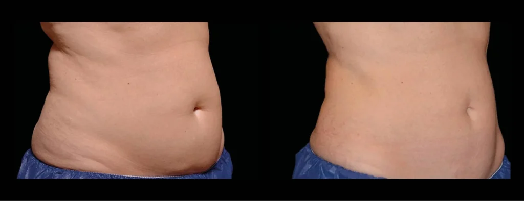 Zonas del cuerpo que puedes tratar con Criolipólisis