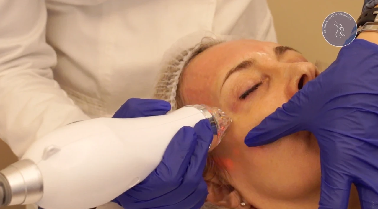 Tratamiento Facial de Radiofrecuencia con Microagujas